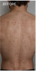 Back acne before using RAVN, subject 2