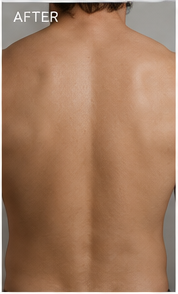 Clearer back after using RAVN, subject 1