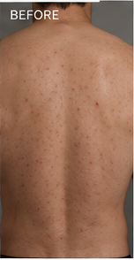 Back acne before using RAVN, subject 3
