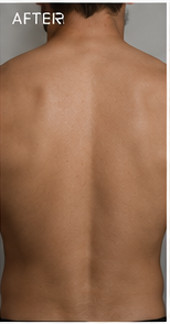 Clearer back after using RAVN, subject 2