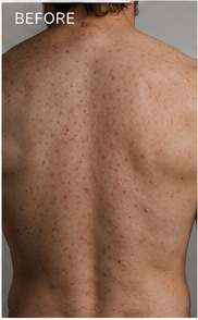 Back acne before using RAVN, subject 1